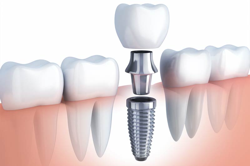 Implants Dentist in Redondo Beach