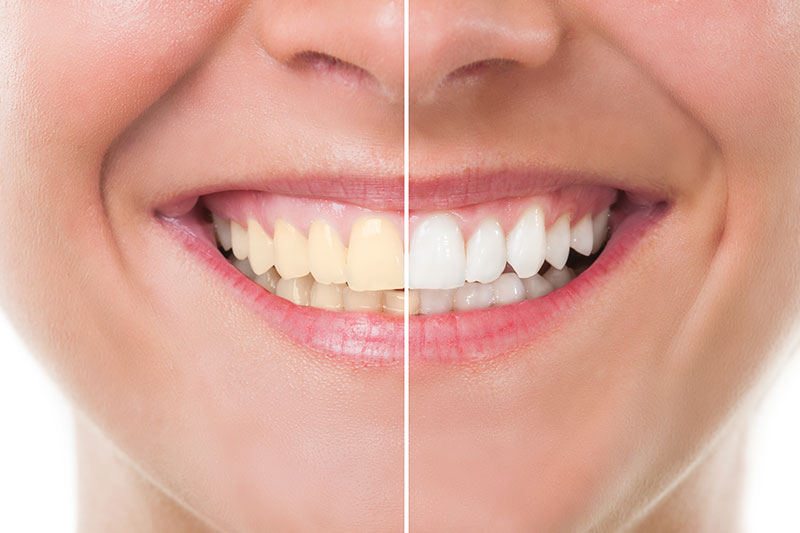 Teeth Whitening in Redondo Beach